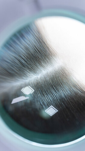 Esami Bulbi Capillari Bari